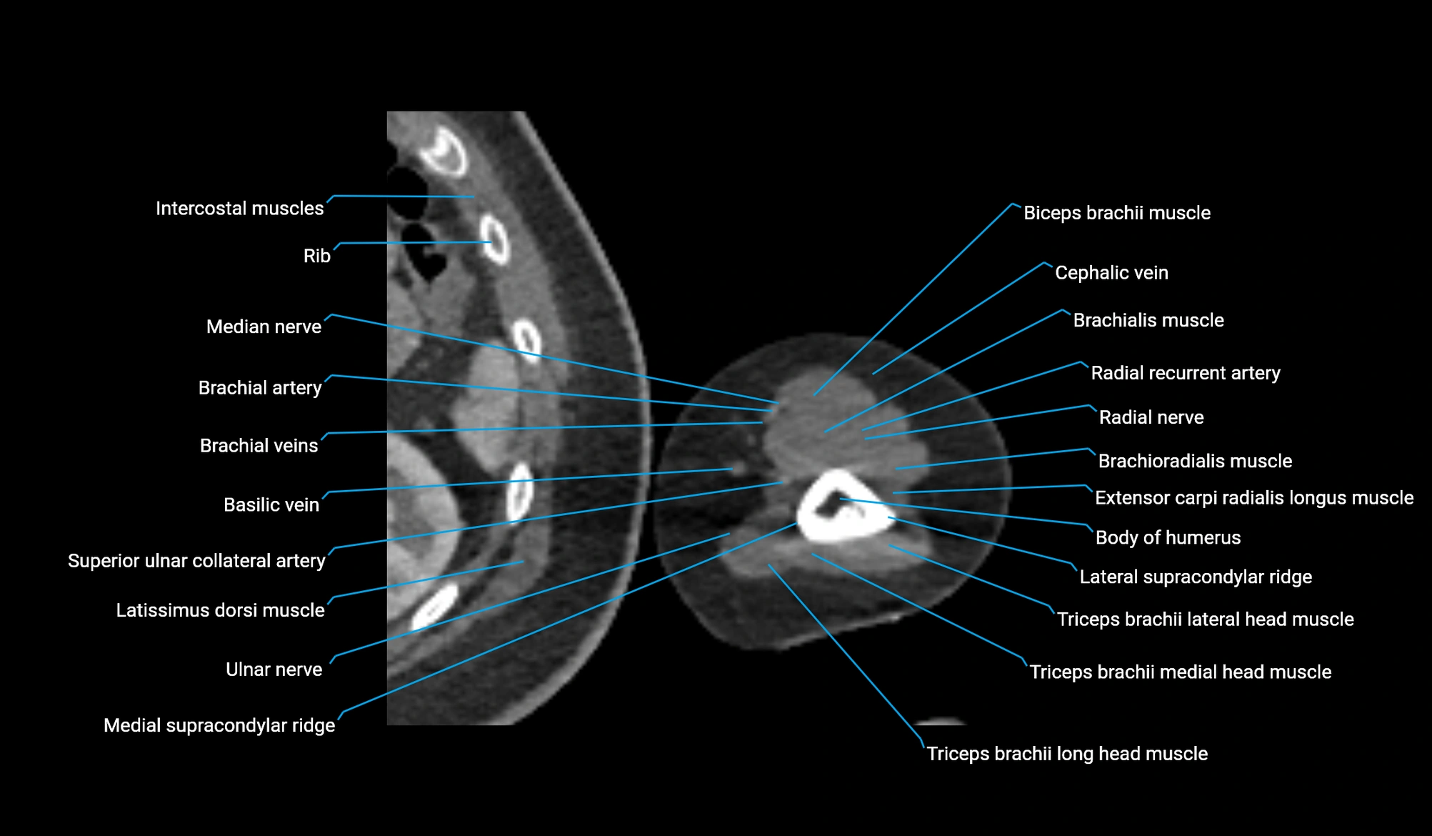 CT upper arm axial  cross sectional anatomy labelled radiology image -00340.webp